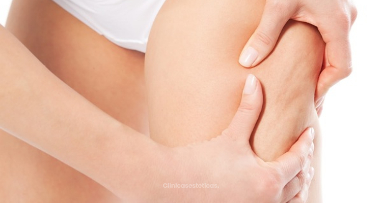 cuanto cuesta eliminar estrias con laser