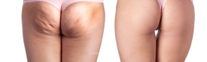 Cavitacion estetica antes y despues de adelgazar